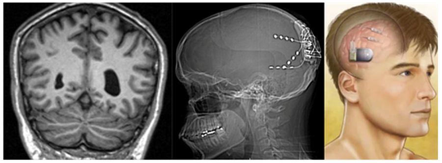 ■ 양쪽 후두엽에서 발생하는 뇌전증 환자의 양쪽 후두엽에 RNS 신경자극기를 삽입해 발작의 발생을 막는 모습(미국 자료).