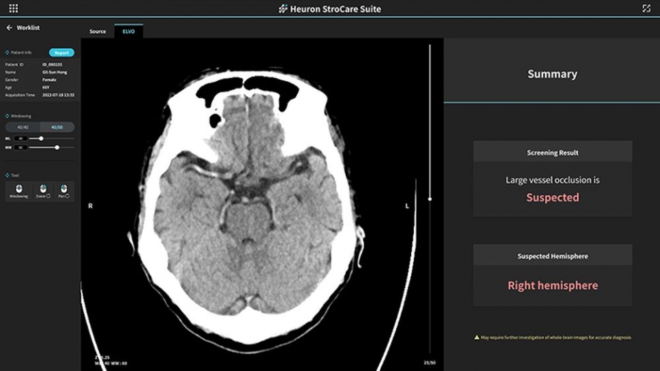 휴런의 AI 솔루션 '휴런 스트로케어 스위트'(Heuron StroCare Suite) 구동 모습.