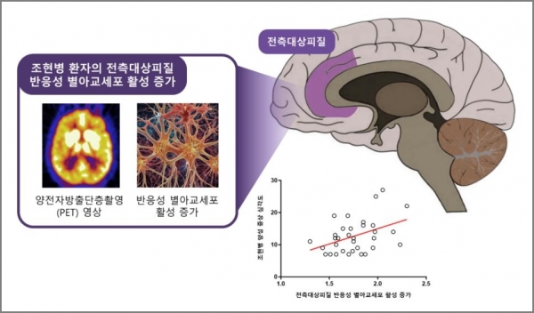 [그림] 조현병 환자의 뇌 속 전측대상피질에서 반응성 별아교세포(뇌 염증 반응 및 글루타메이트 조절 이상 시사)의 활성 증가를 확인했다. 또한, 조현병 환자에서 전측대상피질의 반응성 별아교세포 활성이 증가할수록 환청·망상 등 조현병 양성 증상이 심각하다는 것을 확인했다. ⓒ의협신문