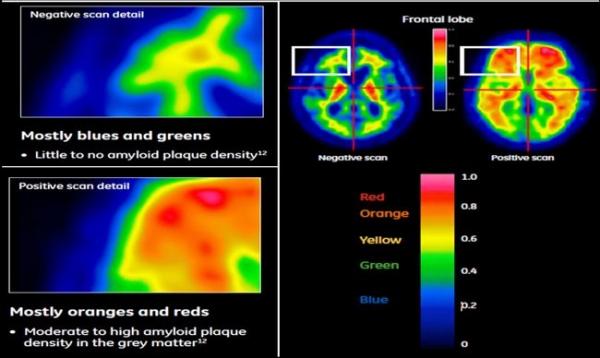 치매 진단 방사성의약품 '비자밀'을 이용한 진단 이미지. 색상이 블루 및 그린인 경우 베타 아밀로이드 신경반 밀도가 거의 없다고 판단하며, 오렌지 및 레드일 경우 중증도 이상의 알츠하이머성 치매일 가능성이 높다.