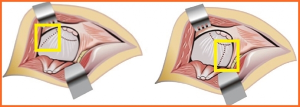관절낭 위쪽을 절개하는 기존 수술법(왼쪽), 관절낭 아래쪽을 절개하는 파이코 수술법(오른쪽). ⓒ의협신문
