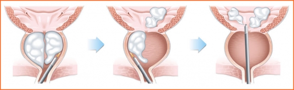 홀렙수술 모식도. 비대해진 전립선 조직을 홀뮴레이저로 완전히 제거하는 '분리 적출술' 방법이다. ⓒ의협신문