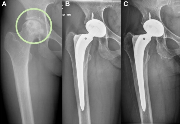 A는 대퇴골두 골괴사로 함몰된 27세 여성의 수술 전 단순 방사선 사진이다. B는 3세대 세라믹 인공고관절 전치환술 후 10년째, C는 26년째 추적관찰 사진이다. 수술 후 25년이 지났음에도 부작용 없이 인공고관절이 잘 유지되고 있다. ⓒ의협신문